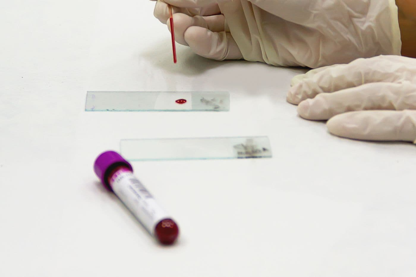 Blood sample and slides prepared for laboratory analysis